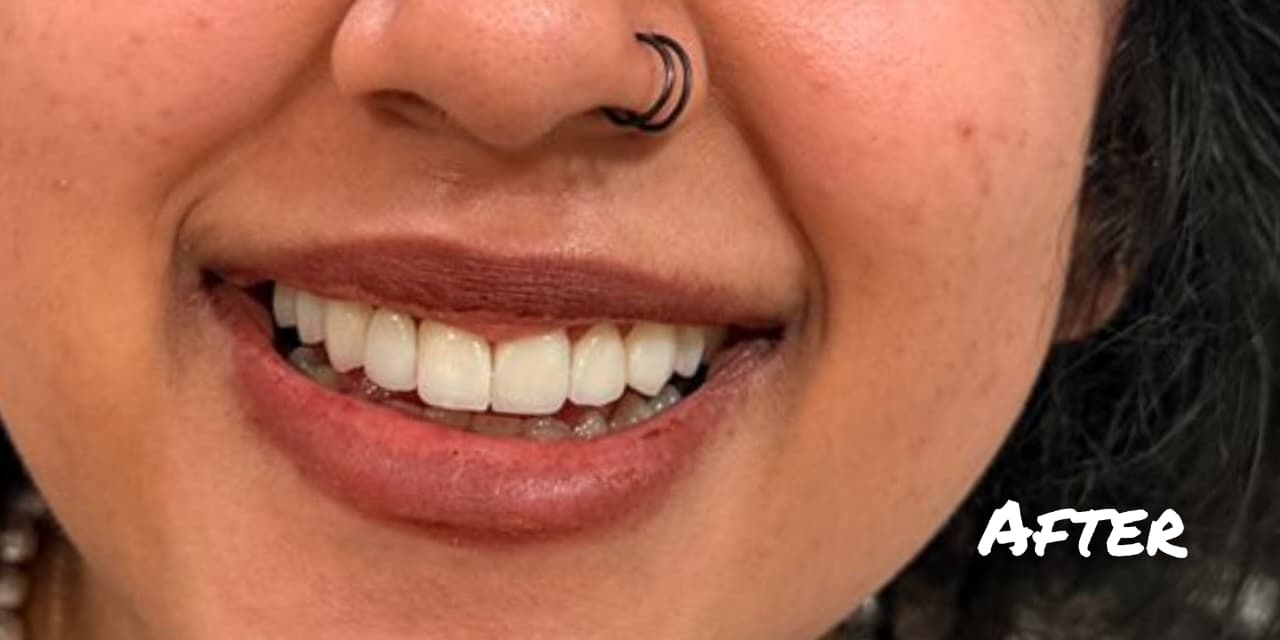 After treatment