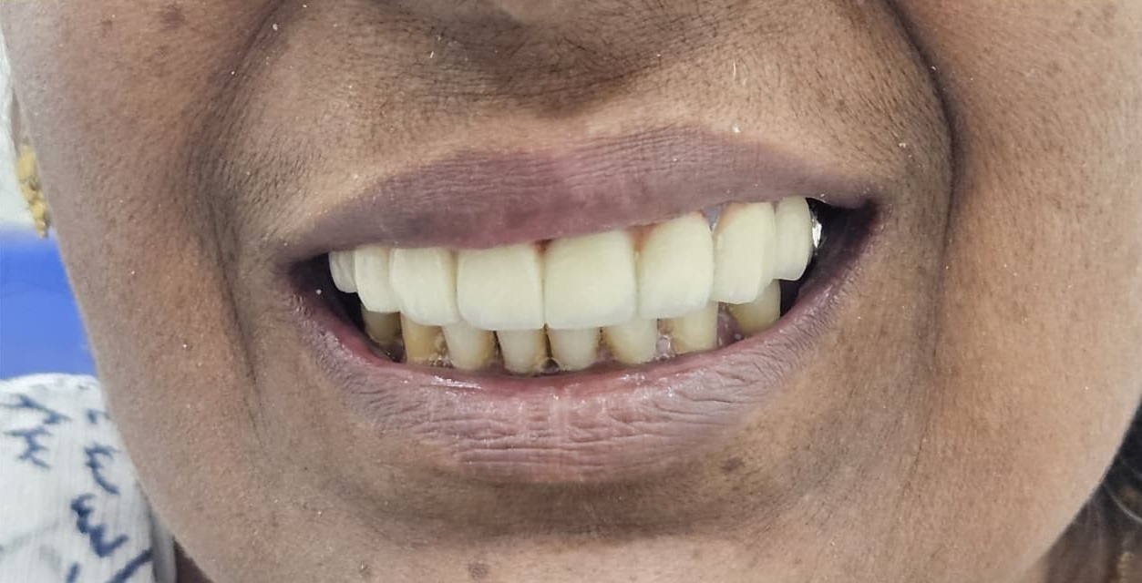 After treatment