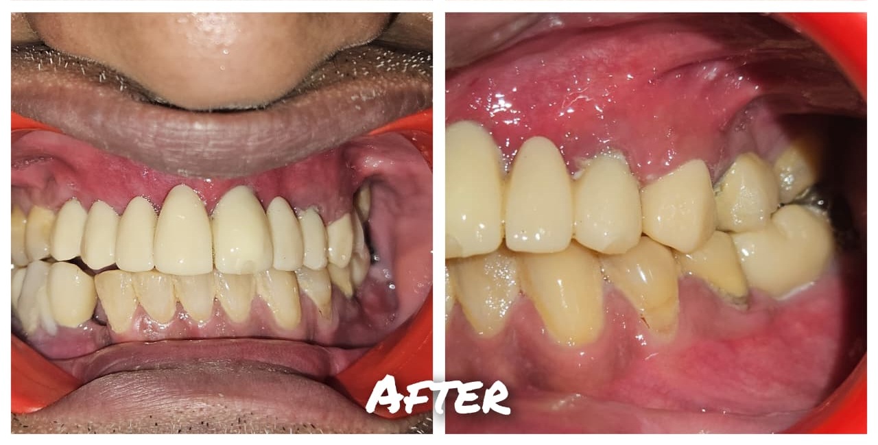 After treatment