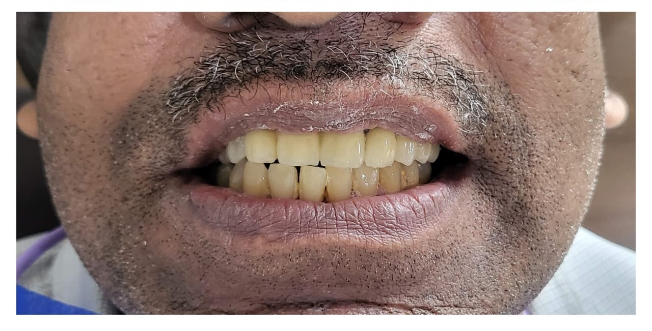 After treatment