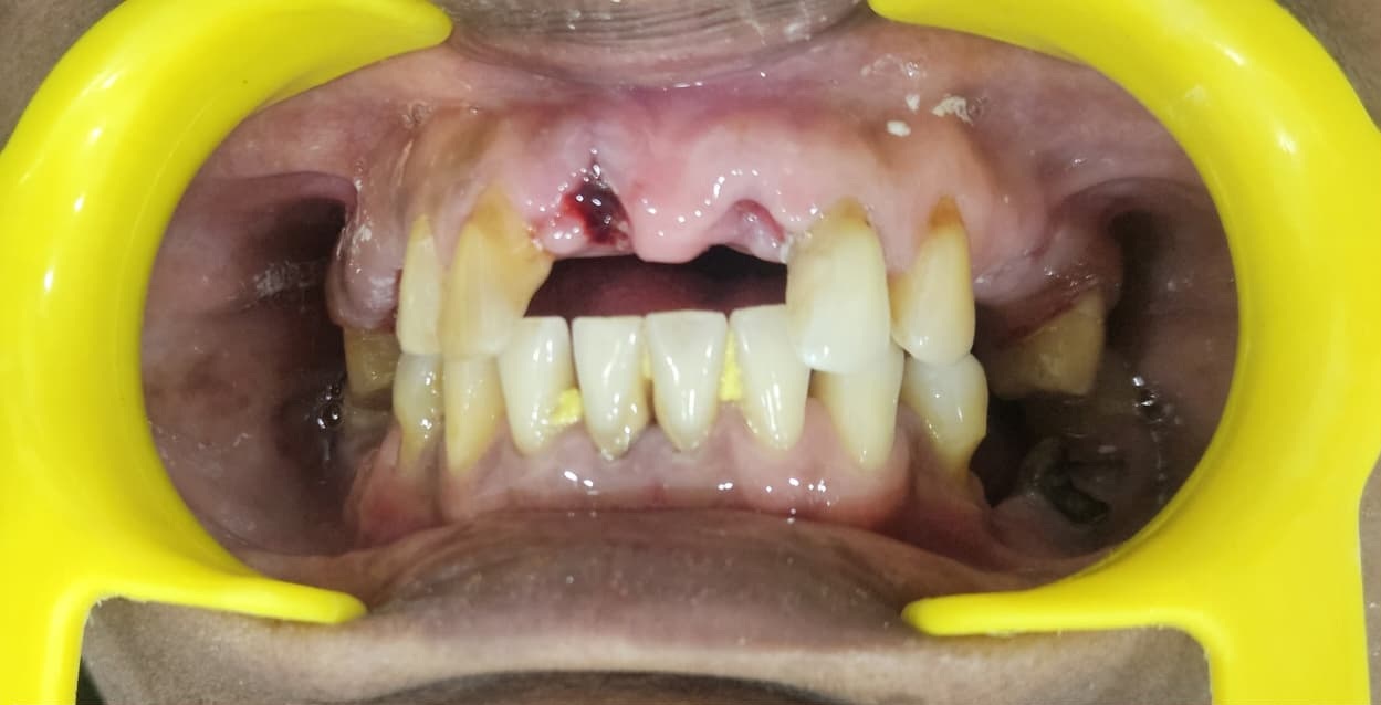 Before treatment